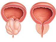 prostatitis