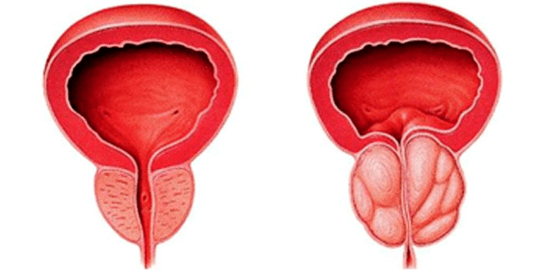 Normal and inflamed prostate